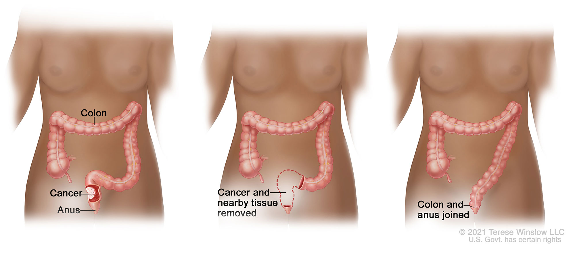 An illustration of the colon within the human body and identifying where the cancer may be located and then removed.